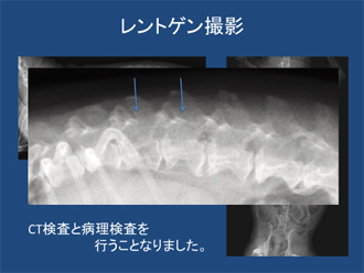 多発性骨髄腫