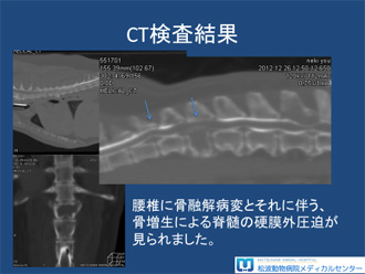 多発性骨髄腫