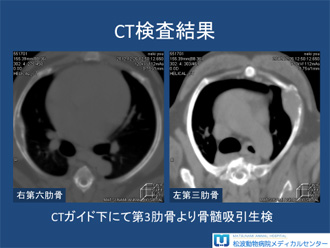 多発性骨髄腫