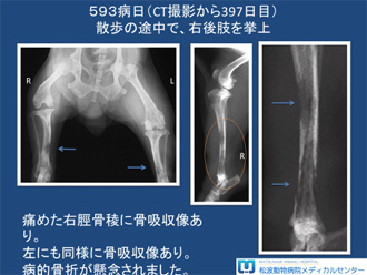 多発性骨髄腫