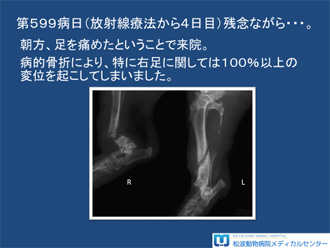 多発性骨髄腫