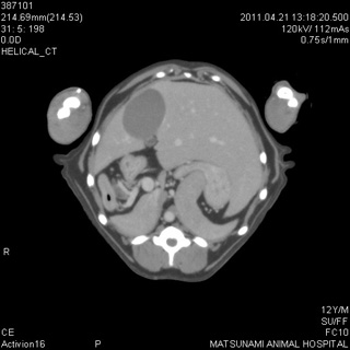 肝臓CT横断面